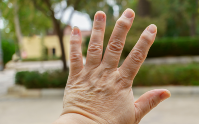 Tratamento para Artrose em Casa: Foco em Mãos e Joelhos no Ibirapuera